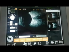 جهاز المسح الضوئي للمروحة B بتردد 10 ميجاهرتز لمراقبة انفصال الشبكية