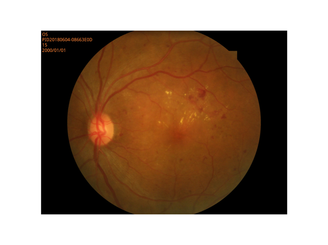 تصوير شبكية العين الكاميرا الرقمية القاعة وضع التلميذ الصغير عالية الدقة