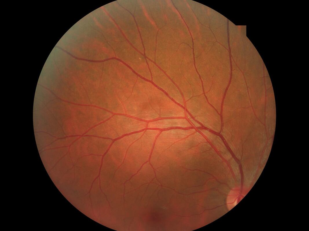 Non Mydriatic Fundus Camera with ±25D Diopter Compensation 9-position Mosaic Function and 100-240v 50/60HZ Power Supply
